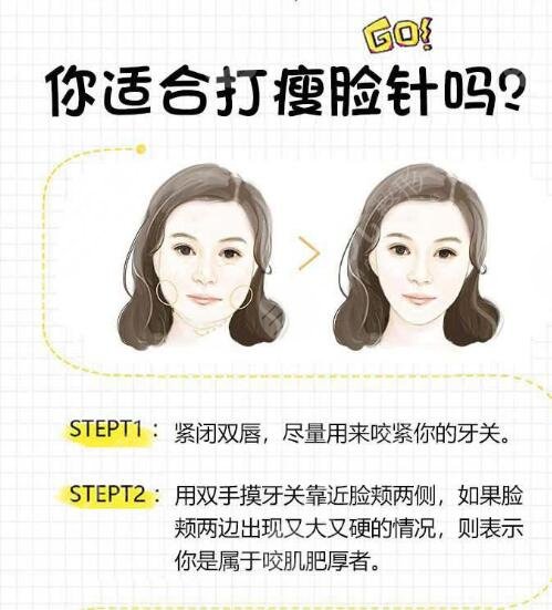 注射瘦脸适宜人群
