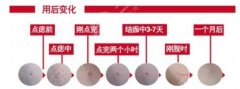 药水点痣掉痂后正常图片，对比激光点痣果
