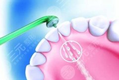 为什么医生不推荐洗牙？洗牙会让牙缝变大吗？
