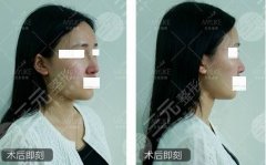注射隆鼻和假体隆鼻哪个果好？可靠性|维持时间|价格