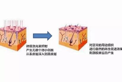 什么是飞梭镭射?