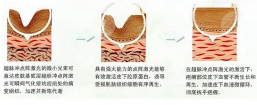 什么是点阵激光?