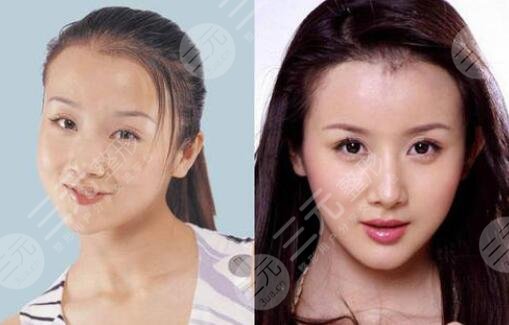 孙菲菲整容了吗?来看她前后的变脸历史!