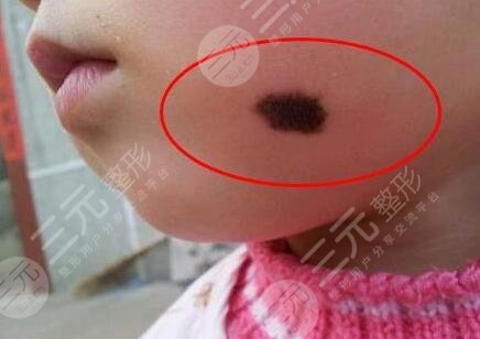 胎记怎么去除?