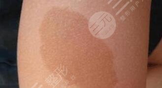 胎记去除挂什么科?