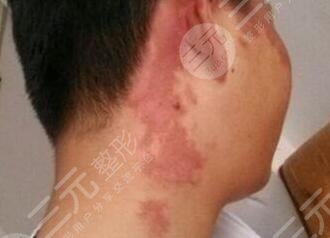 去除胎记后的护理