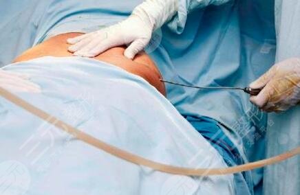 什么是吸脂减肥塑型