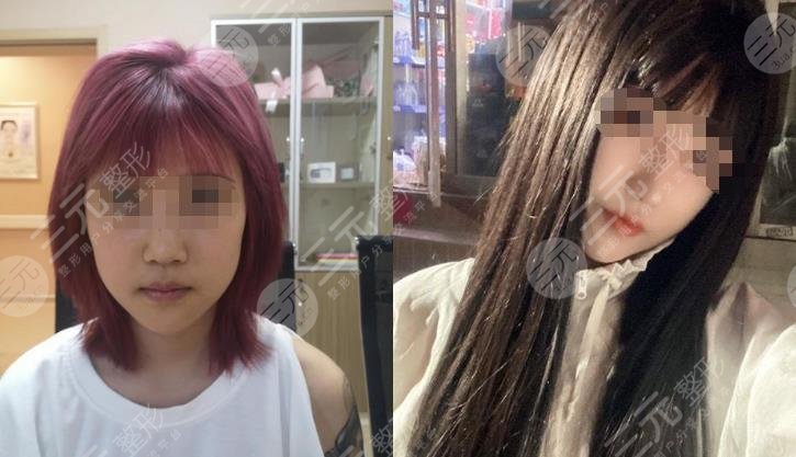 脸部填充案例