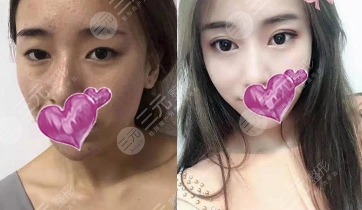 南通第一人民医院美容整形科双眼皮案例