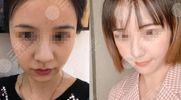 上海九院做光子嫩肤过程图片