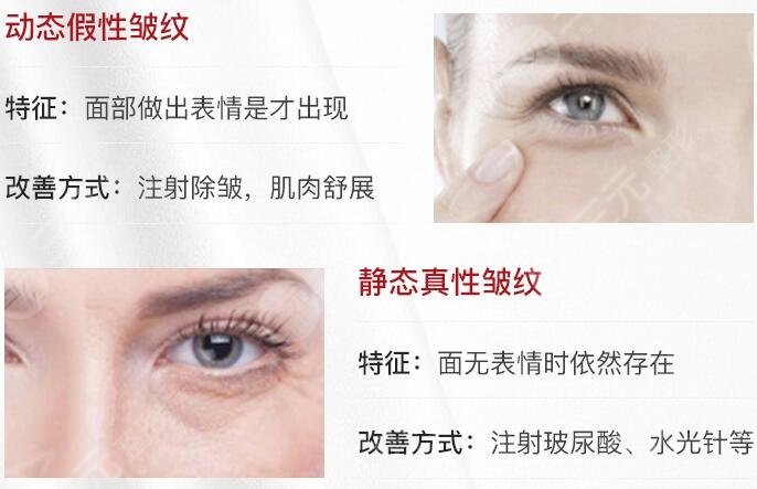 皱纹