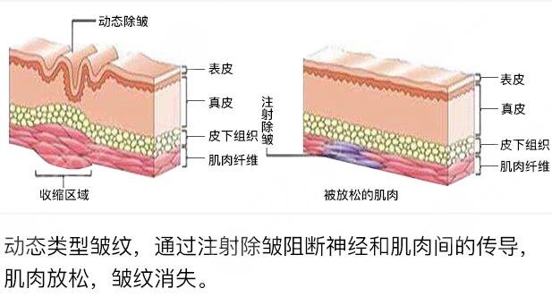 注射除皱