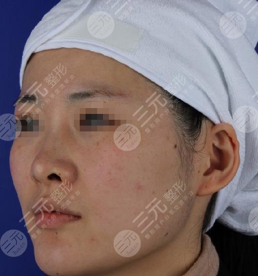 光子嫩肤果对比照片