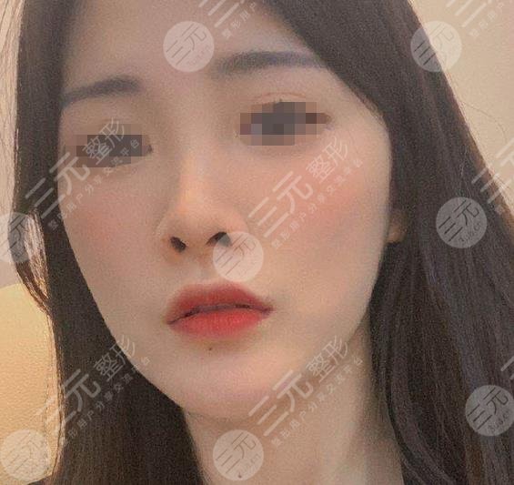 光子嫩肤果对比照片