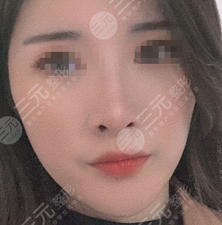 光子嫩肤果对比照片