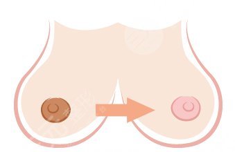 乳头乳晕整形术科普！手术过程|多少钱|注意事项一览！