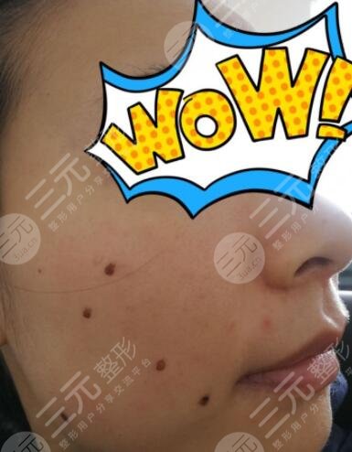 激光点痣10天后的图片:总算是告别了满脸的黑痣!