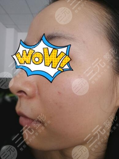 激光点痣10天后的图片:总算是告别了满脸的黑痣!