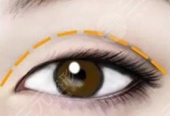 双眼皮8mm恢复自然后有多宽？这篇科普教你如何get美丽电眼！