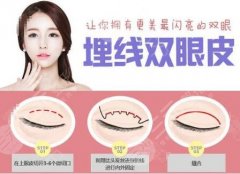 埋线双眼皮维持多久？适合哪些人？美眼小秘籍分享！