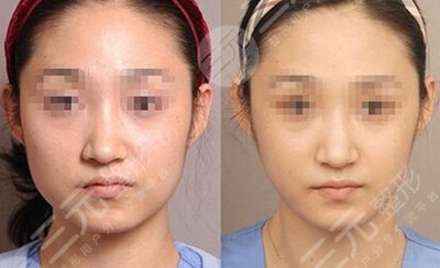 瘦脸对比照