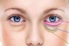 去眼袋手术报价是多少？去眼袋手术恢复时间是多久？