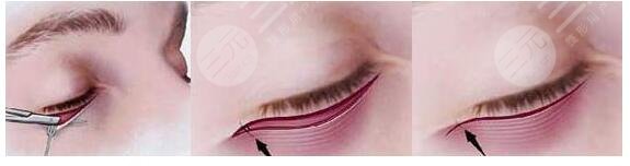 去眼袋手术恢复时间