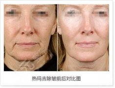 热玛吉多久做一次比较好?超火抗衰轻医美,这样做才科学! 热玛吉多久做一次比较好?超火抗衰轻医美,这样做才科学!