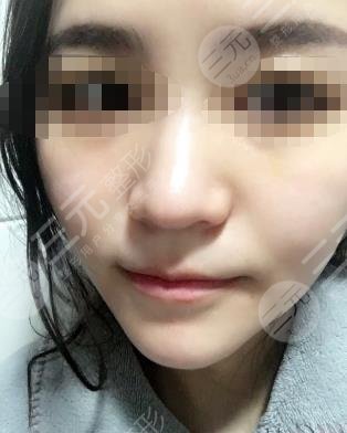 热玛吉提升