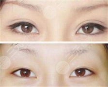 双眼皮翘睫术前后图片：真人体验双眼皮翘睫果~