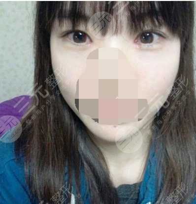术后的一个月