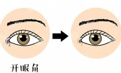 10个开眼角9个留疤是真的吗？如何避免开眼角留疤？