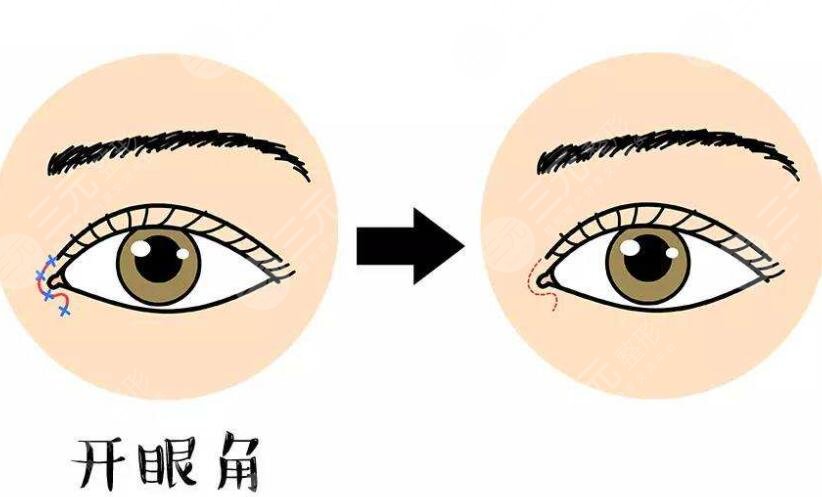 10个开眼角9个留疤是真的吗?如何避免开眼角留疤?