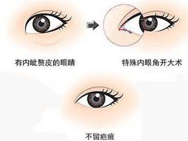 10个开眼角9个留疤是真的吗?