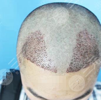 植发1500个毛囊单位多少钱真人植发1500个毛囊单位果展示