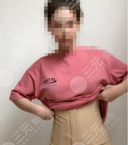 抽脂手术之前