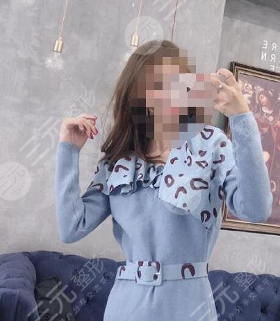 抽脂手术之后