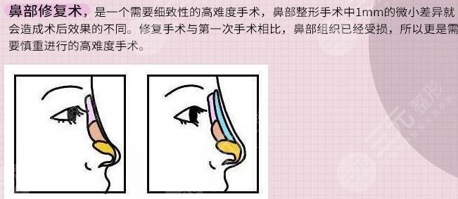 隆鼻失败修复术是怎么做