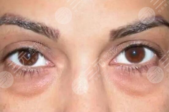 去眼袋手术报价是多少？去眼袋手术恢复时间是多久？