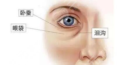 去眼袋手术恢复时间是多久？