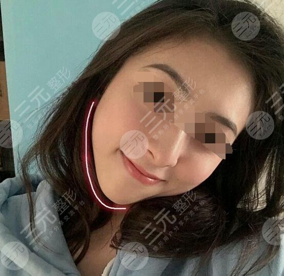 真人体验注射瘦脸注射后一个月