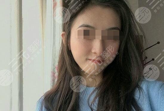 真人体验注射瘦脸注射后2个月