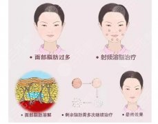 射频溶脂有果吗？注意事项有哪些？