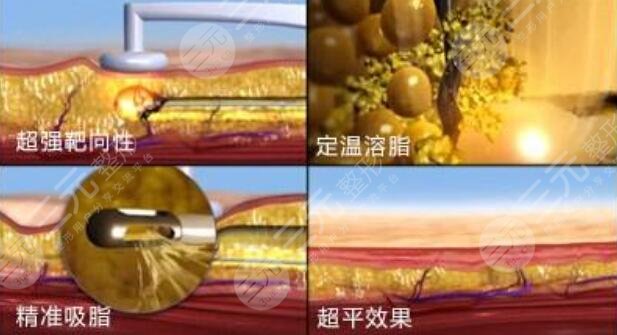 射频溶脂原理