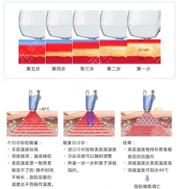 射频溶之前需要注意的事项