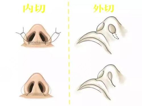 怎么缩小鼻头