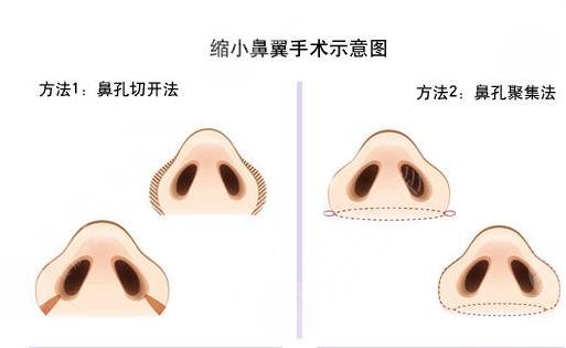 鼻头缩小注意事项