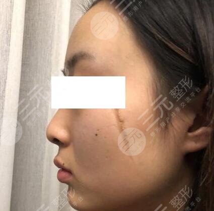 304医院整形科激光祛疤果图