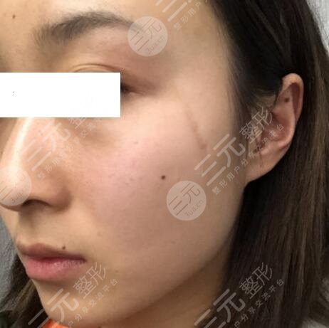 304医院整形科激光祛疤果图
