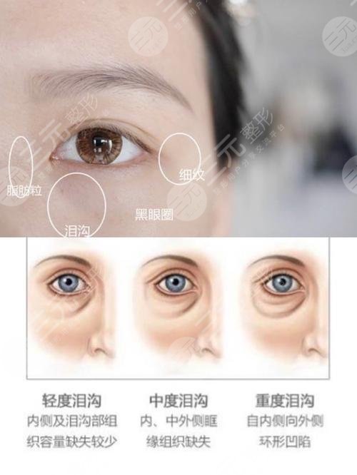 自体脂肪填充泪沟术后护理工作
